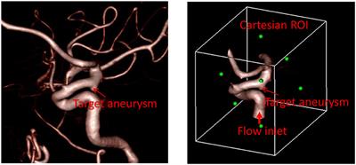 A Highly Automated Computational Method for Modeling of Intracranial Aneurysm Hemodynamics